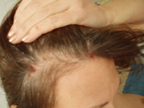 Rachel headsores